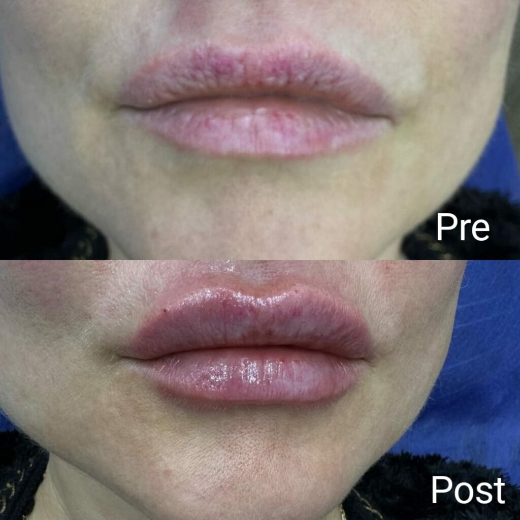 هيالورون نفخ الشفايف قبل وبعد